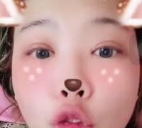 切开双眼皮+开眼角手术前后对比图恢复过程 昆山时光整形医院