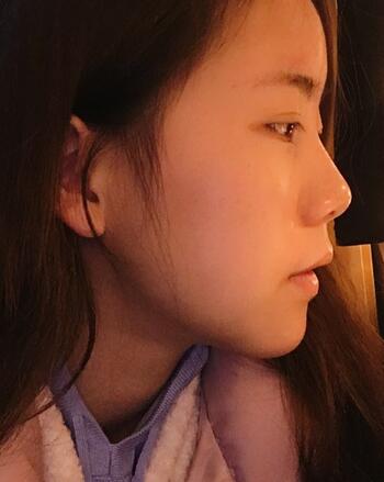 北京艺星王英勇隆鼻案例 鼻综合三个月