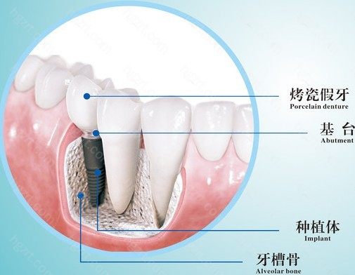 种植牙钛合金好还是纯钛好？一级钛到5级钛的区别是啥？