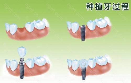 西安雁塔区牙科医院哪家好？哪个做种植牙便宜又好？