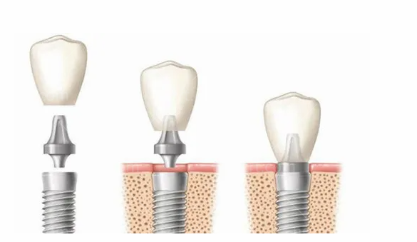 海曙口腔医院3500就可以种植牙，解决缺牙问题，医保种植牙是不是可以报销
