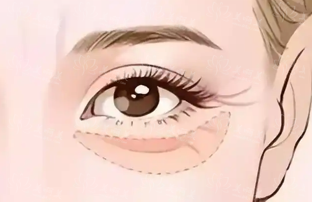 如何有效去除双眼皮手术后的疤痕?